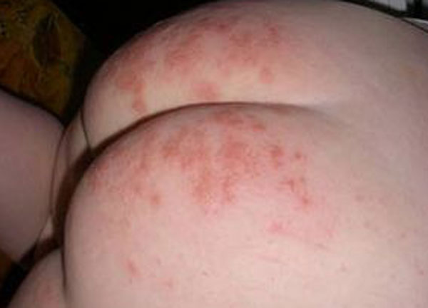 алергія - часто з'являється на обличчі, на щоках, в складках шиї і рук;