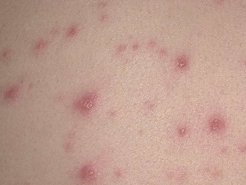 Алергія на статевому члені є захворювання, при якому організм чоловіка відрізняється підвищеною чутливістю до повторного дії алергену