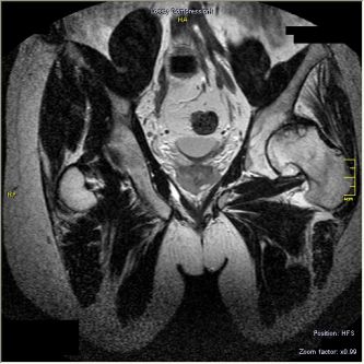Рентгенівський знімок лівого кульшового суглоба до лікування (2004)