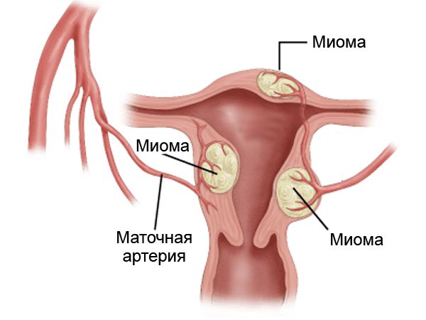 Міома - дуже часте гінекологічне захворювання, що зустрічається у 30% жінок