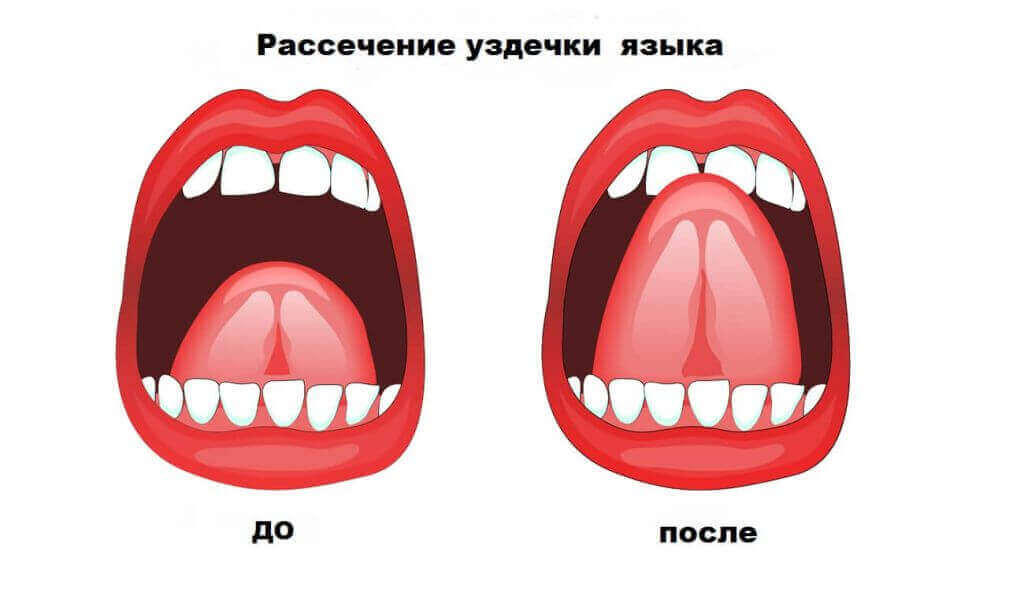Пластика вуздечки язика   вважається нескладною і швидкої стоматологічної маніпуляцією