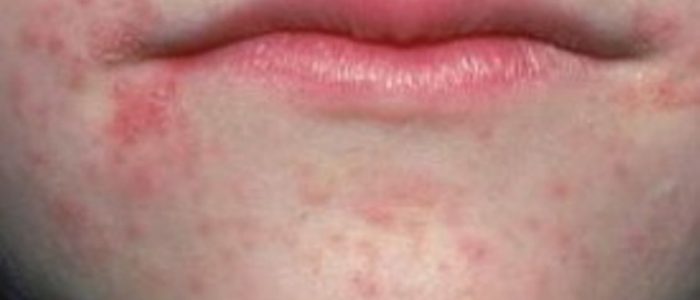 Прибрати прищі біля губ можна за допомогою медикаментозного лікування, косметологічних процедур, а також засобами народної медицини