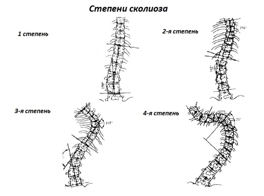 торокальний (грудної) сколіоз;   люмбальний (поперековий) сколіоз;   тораколюмбальной сколіоз - одне викривлення в зоні грудопоясничного переходу;   комбінований сколіоз - S-подібне викривлення, що поширюється на грудної і поперековий відділ хребта