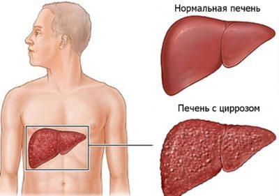 У людей з цирозом печінки джерелом кровотечі можуть стати розширені варикозні вени стравоходу