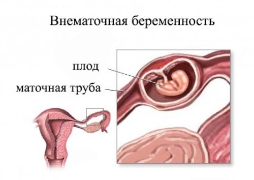 Ускладнення вагітності, при якому прикріплення заплідненої яйцеклітини відбувається поза порожниною матки внаслідок наявності спайок в маткових трубах в результаті локалізації там запального процесу
