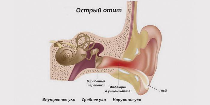 зовнішнє - захворювання протікає зовні, розвивається фурункул зовнішнього вуха, коли інфекція проникає в сальні або волосяні мішечки, може досягти барабанної перетинки;   середнє - катаральне, в порожнині середнього вуха (простір між перетинкою і внутрішнім вухом);   внутрішнє - виникає всередині, зачіпає глибоко лежачі органи і лабіринт, найнебезпечніший підвид