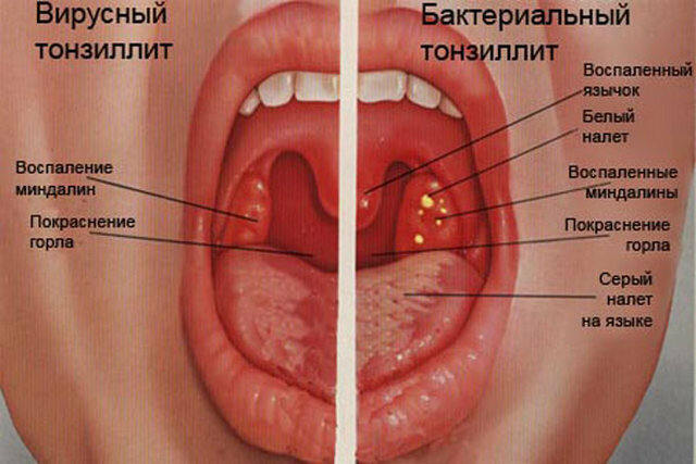 ангіна (гостре інфекційне захворювання з переважним ураженням піднебінних мигдалин) - характерна сильна біль при ковтанні, що супроводжується порушенням загального стану, підвищенням температури;   тонзиліт (хронічне запалення піднебінних мигдалин) - характерно відчуття першіння, саднения в горлі, відчуття стороннього тіла в області мигдалин, неприємний запах з рота, незначні болі при ковтанні, субфебрильна температура;