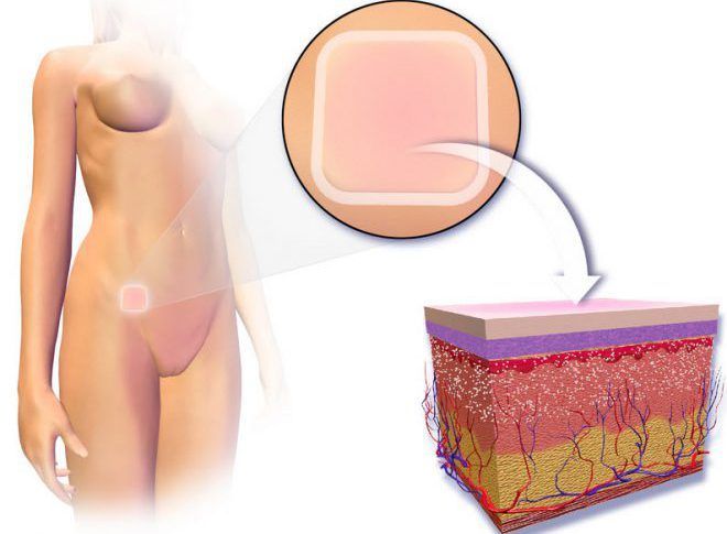 Наявність внутрішньоматкової спіралі (особливо в перший місяць застосування), використання протизаплідних пластирів і вагінальних кілець з комбінованими контрацептивами можуть спровокувати появу рожевої слизу з піхви