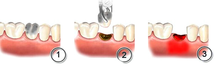 Альвеолит - це запалення лунки, що залишилася на місці видаленого зуба