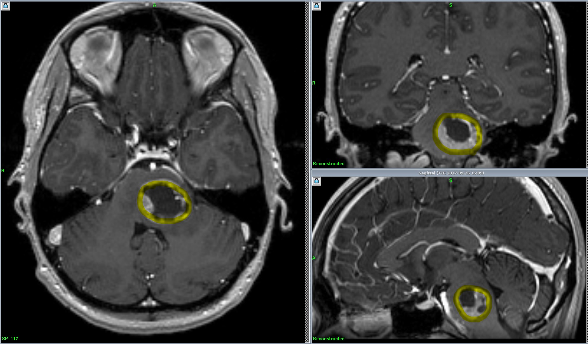Так виглядає метастаз в головний мозок (розташований в стовбурі головного мозку, виділений жовтим контуром), виявлений при МРТ з контрастуванням