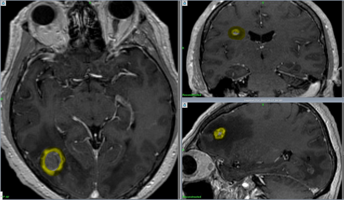 Множинні метастази в головний мозок у пацієнта з первинним раком нирки