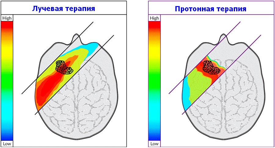 Схематичне порівняння лікування метастазів в головний мозок протонами і іншими методами променевого лікування