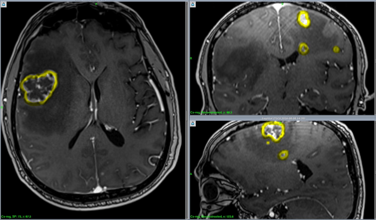 Метастази в головний мозок на МРТ: знімки пацієнта, який лікував рак легені методом нетрадиційної медицини, а потім звернувся в Онкологічну клініку МІБС для лікування метастазів в мозок