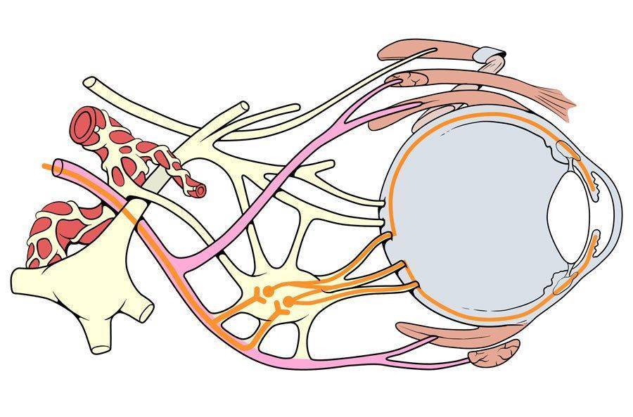 Якщо з'являється ретробульбарний неврит, запалення зазвичай розташовується лише на очному яблуці