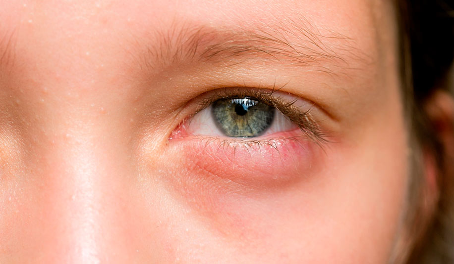 Побілілий зіницю, поступове поява косоокості, відсутність бінокулярного зору - все це характерно для ретинобластоми (відзначимо, що це часто діагностуються патологія у пацієнтів молодого віку)