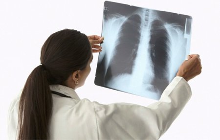 Запалення легенів   Деякі люди навіть не підозрюють, до чого може привести запалення легенів