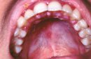 Запалення порожнини рота, або стоматит, відноситься до найбільш частих захворювань порожнини рота, з яким доводиться стикатися стоматологам і викликатися ця хвороба може найрізноманітнішими причинами