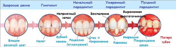 При прогресуванні процесу, запалення поширюється на всі тканини оточують зуб