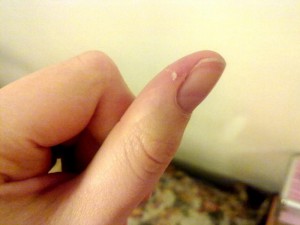Нерідко після манікюру або без будь-яких видимих ​​приводів, може з'являтися запалення біля або навколо нігтя на руці