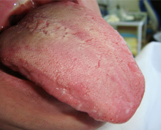 Захворювання загострюється після повторного контакту з алергеном