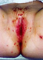 Герпес у жінок починається з болю внизу живота і в області статевих органів, порушень сечовипускання, гноевідних виділень з піхви