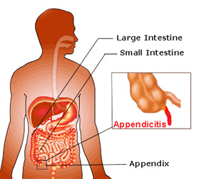 Апендицит - це запалення відростка сліпої кишки, яке вимагає якнайшвидшого хірургічного втручання