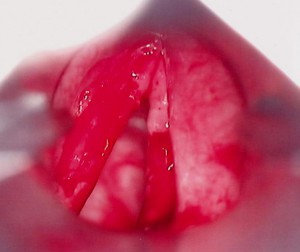 Передумовами до розвитку раку горла є часті і затяжні тонзиліти, отити, фарингіти, а також хронічні запальні захворювання зубів, носоглотки, голосових зв'язок