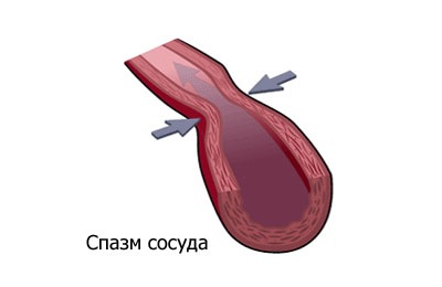 В результаті спазму судинних стінок відбувається звуження судинного просвіту, що призводить до зменшення хвилинного об'єму крові, що проходить по ним