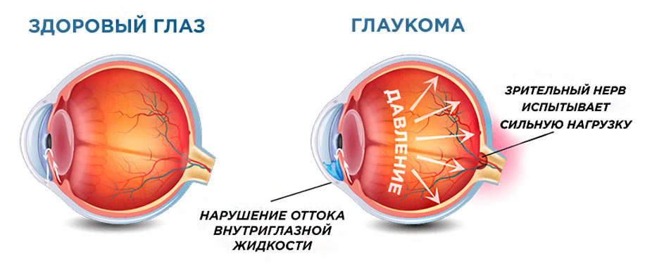 Виникає внаслідок вікових змін в очному яблуці, при порушенні кровопостачання внутрішньоочних структур і нервової регуляції функцій очі, через прогресування далекозорості або короткозорості, генетичної схильності