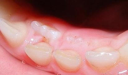 Догляд за зубками в період їх випадання включає в себе ретельну   гігієну порожнини рота   і   профілактику карієсу