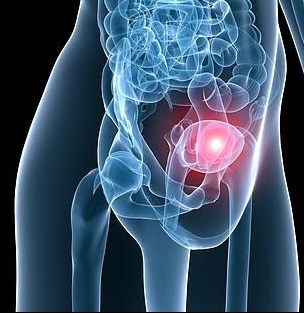 Рак вульви найбільш часто виникає у жінок після 65-70 років і становить не більше 4% від загального числа онкологічних захворювань репродуктивної системи у жінок