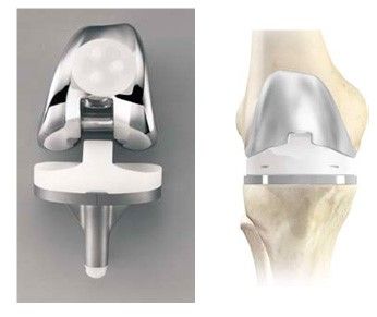 Операція ендопротезування колінного суглоба - технічно дуже складна процедура