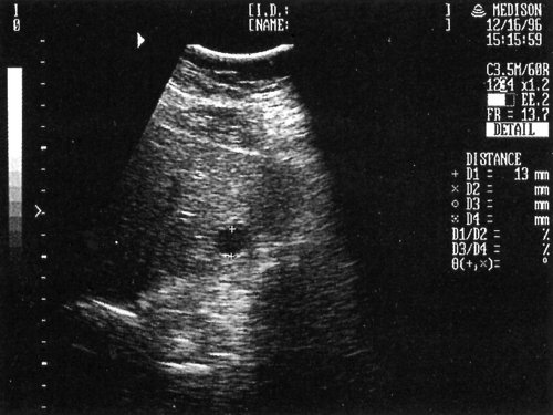 Ехографіческая картина одного з варіантів зображення капілярної гемангіоми лівої частки печінки
