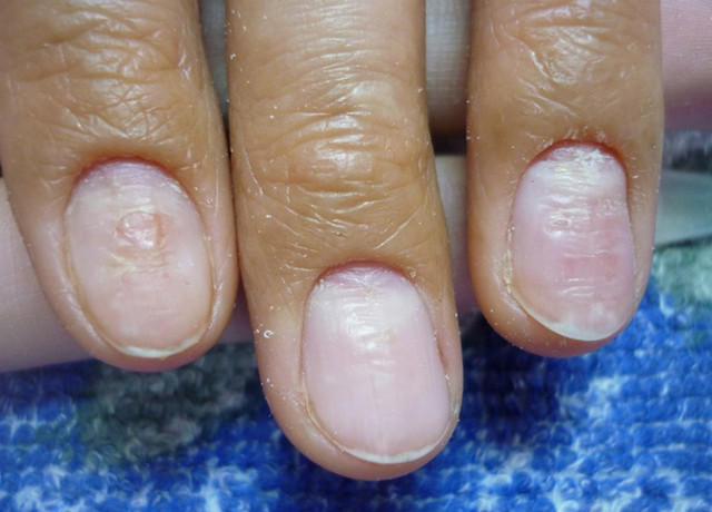 Якщо шаруються нігті і з'являються борозни, то можна говорити і про грибку, як про можливу причину захворювання:   Оніхомікоз (грибок нігтів) - сіпмптомов, лікування, ліки