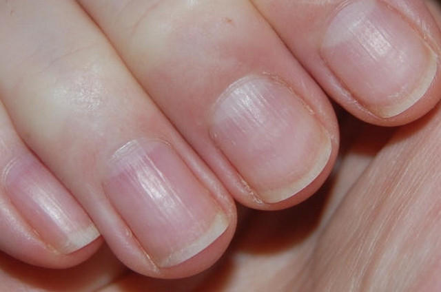 При незначному пошкодженні нігтя і правильному манікюрі через 3-6 місяців виростає ніготь правильної форми