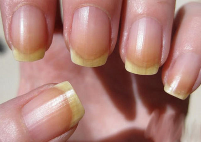 Жовтувато-зеленувата забарвлення нігтів може виникати при тривалому гнійному процесі в організмі, і не обов'язково це повинні бути абсцеси - це можуть бути уповільнені тонзиліти, синусити та інші