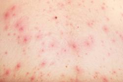 Деякі інфекції, що передаються статевим шляхом (ІПСШ), здатні викликати появу   висипу на шкірі