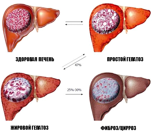 На даній картинці ви можете побачити динаміку патологічних процесів у печінці в процентному співвідношенні, статистично