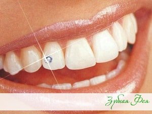 Скайс на зуб - це мініатюрне прикраса, що робить посмішку ексклюзивної та незабутньою