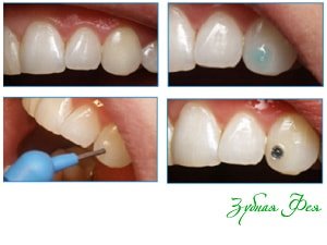 Перед установкою прикраси поверхню зубів очищається від зубного та пігментного нальоту, полірується, при необхідності проводиться   професійна гігієна