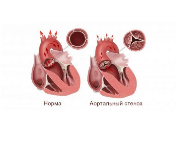 Навіть при малому відкритті аортального клапана кров все одно надходить в аорту, але не в повному обсязі: частково вона так і залишається в серці, поступово розтягуючи його стінки