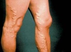 Тромбофлебіт, фото якого ви бачите зліва, - поширене захворювання поверхневих вен, що характеризується запаленням венозних стінок і освітою кров'яних тромбів