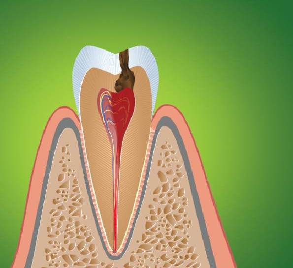 Пульпа - це пучок нервово-судинних волокон, м'яка тканина, що служить прошарком між коронкової частиною зуба і його коренем