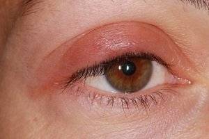 Почервоніння навколо очей може бути ознакою захворювань століття і очей