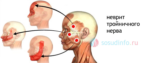 Як правило, біль в таких випадках локалізується в області чола або в скроні (неврит трійчастого нерва)