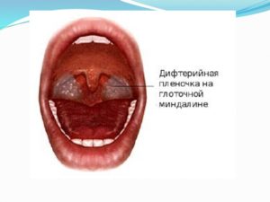Грибок в горлі необхідно обов'язково диференціювати з розвитком дифтерії, оскільки при ураженні пліснявими грибами утворюється жовтий наліт, важко відокремлюваний від поверхні глотки - симптом, дуже схожий на діфтеріческіе нальоти