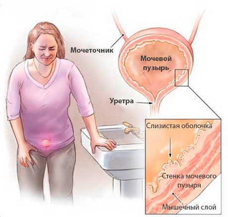 У пацієнток з симптомами циститу, але відсутністю патогенної мікрофлори в сечі, діагностують інтерстиційний   цистит