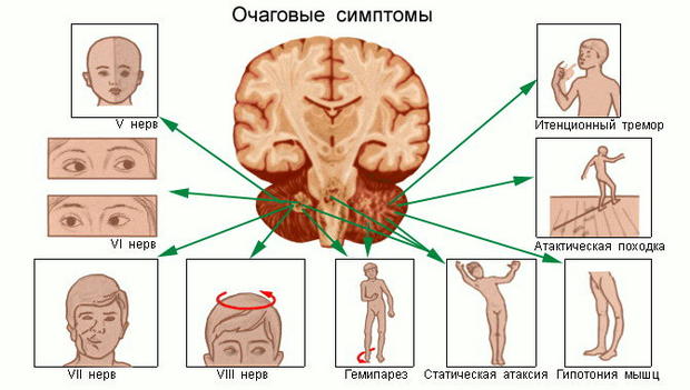 Симптоми пухлини головного мозку