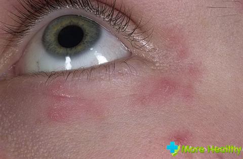 алергічну реакцію на косметичні засоби - креми від зморшок, лосьйони, гелі для вмивання;   механічні пошкодження шкіри навколо очей;   неправильний догляд за шкірою;   паразитарне і грибкове ураження шкіри