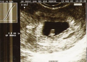 Саме жовте тіло протягом перших трьох місяців вагітності займається виробництвом гормонів - естрогену і прогестерону (на 5 тижні вагітності він досягає свого піку розвитку), пізніше цю функцію візьме на себе плацента